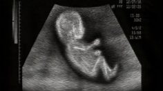 poster-79-valvoline-ultrasound-236x132
